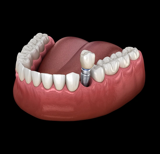 Replace Missing Teeth Restore Healthy Smiles