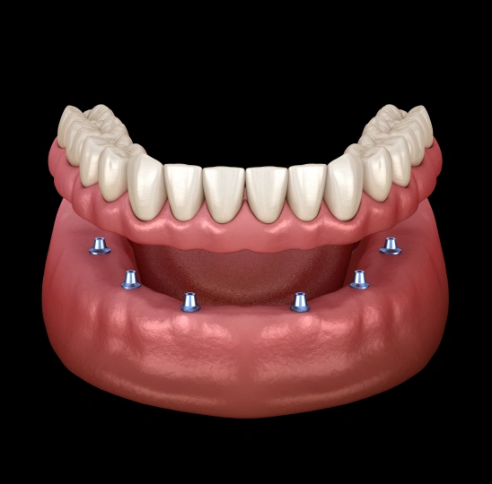 Dentures and Implant Dentures