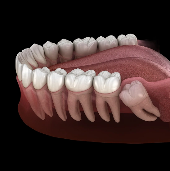 Extractions and Wisdom Teeth Removal